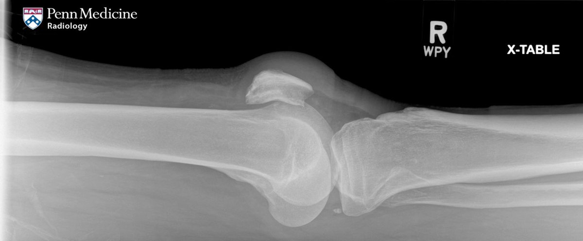AuntMinnie's tweet image. Another case for your consideration #radiology @PennMedicine buff.ly/5OnCUfL