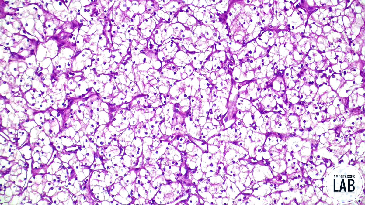 AMontasserMD's tweet image. ISUP grade 1 CCRCC 🫧

#GUpath #PathX #Pathology