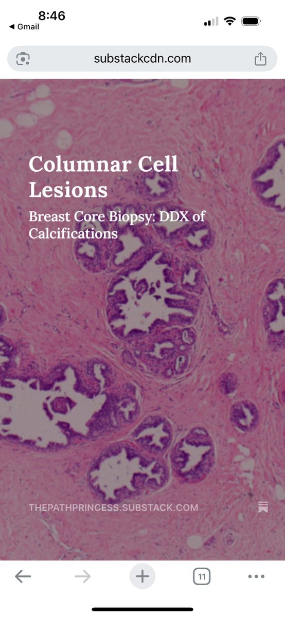 ChelseaMehr_MD's tweet photo. Columnar cell lesions are a common finding in breast biopsies for calcifications. 🕵️♀️🔬✨
https://t.co/ukr9qoqGKq
It's crucial to distinguish between those with and without atypia. Learn more on the Substack!
#pathX #pathtwittter #pathology #pathologist #breastpath https://t.co/4Bg1qdrXvA