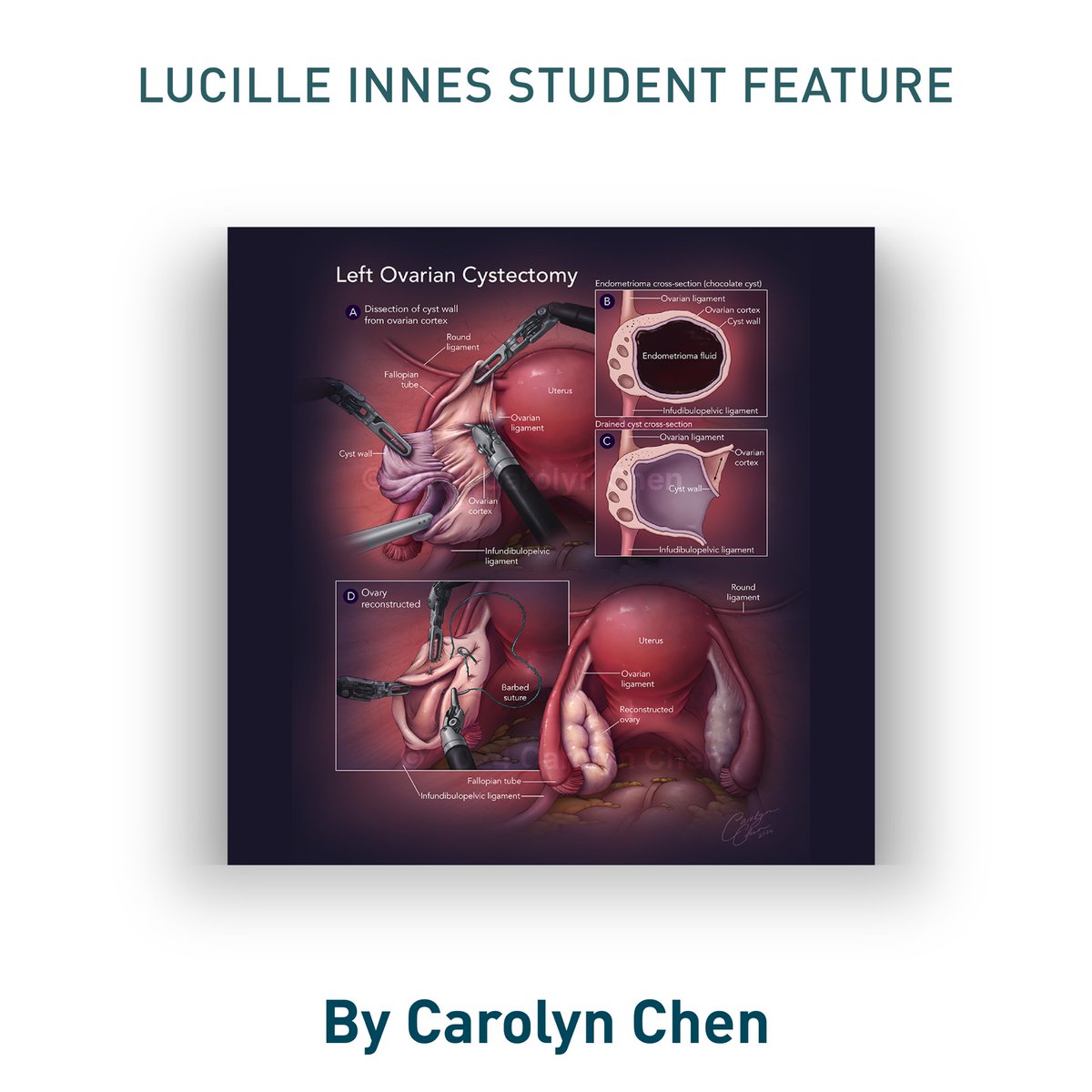 Introducing Carolyn Chen, featured student presenter, at the #VesaliusTrust Lucille Innes Student Showcase on Fri, July 18, 2025 (3:00–4:30 pm) at the <a href="/AMIdotorg/">AMI</a> annual mtg in Grand Rapids, MI. Stop by, meet the recent grads and see what they have been working on. #medart #sciart
