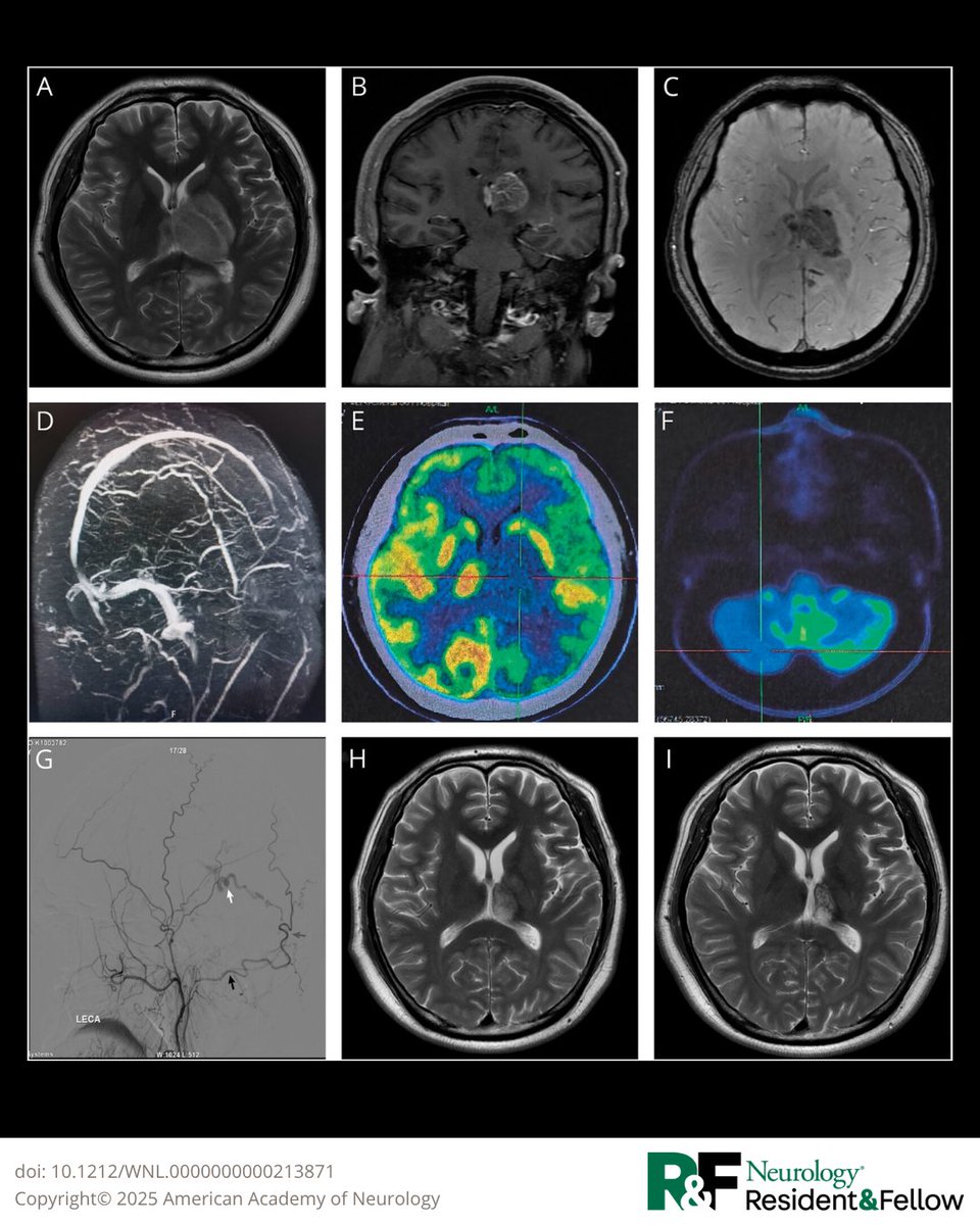 Clinical Reasoning: Acute and Progressive Cognitive Decline in a 38-Year-Old Man
hubs.la/Q03vRbMc0