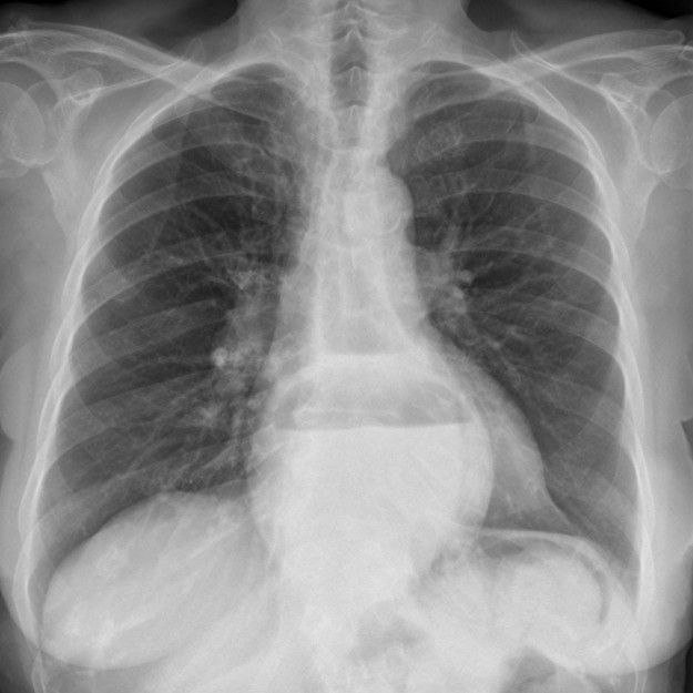 Difficulty on breathing while Lying down after Meals.
What is the diagnosis?