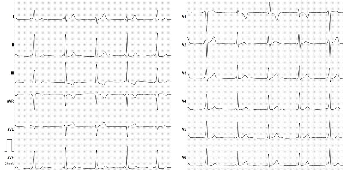 NOT for beginners, NOT easy; ECG from a 17 yo girl with intermittent tachycardias. What do you see?