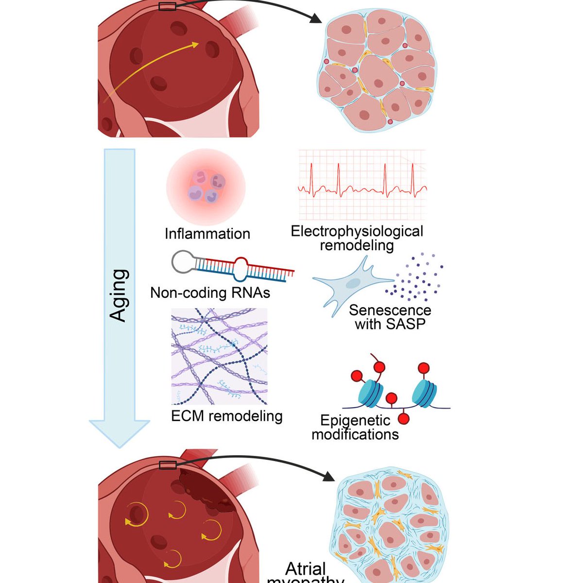 JCA_Journal's tweet image. 🫀Insights on atrial aging!
Time’s imprint on the left atrium: aging and atrial myopathy
👉 Read now: oaepublish.com/articles/jca.2…
#CardiovascularAging #AtrialMyopathy #AgingHeart #AF #HFpEF #JCA