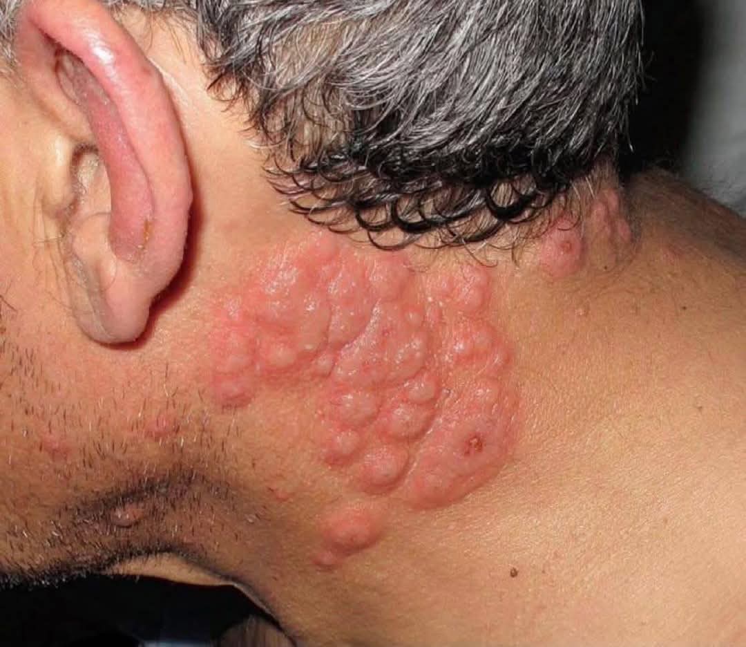 Please don't browse the page, please.

The disease has spread everywhere.

A child is sick all over his body. Please help them as soon as possible.

Their treatment is ineffective, and the weather is making it worse.

Help me get treatment.
gofund.me/5ff4377f