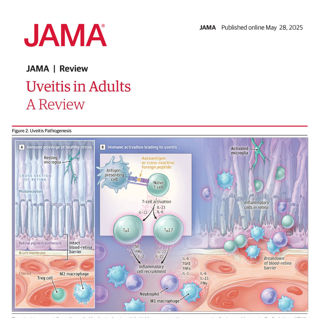 Uveitis is characterized by inflammation of the uvea and primarily affects adults aged 20 to 50 years.

Learn more about the epidemiology, pathophysiology, diagnosis, and treatment of uveitis in this review. 

ja.ma/4lIXKKZ