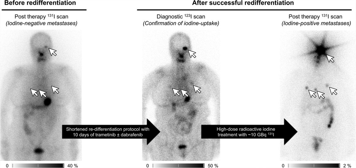JournalofNucMed's tweet image. Short-term tyrosine kinase inhibitor therapy is a feasible approach for restoring iodine uptake in selected patients with metastatic radioactive iodine–refractory thyroid cancer. ow.ly/t99q50W9YHB

#NuclearMedicine #ThyroidCancer #RPTherapy