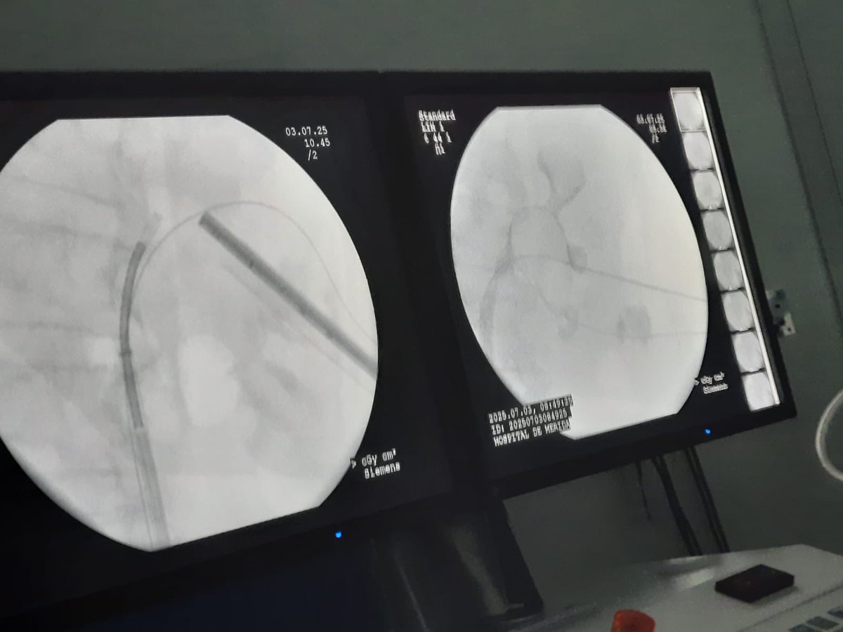j_garre's tweet photo. ¿Sigue teniendo hueco el acceso percutáneo convencional? 
Caso de esta semana: coraliforme completo izq., ECIRS supino con acceso único por GCI. Punción intercostal x GCM por hipermovilidad. Litiasis en cáliz post. sup. resuelta con fURS. 1 tiempo. Libre de litiasis.#UroMérida https://t.co/AIMDv7Ksr1