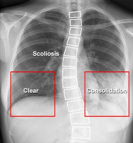 X-RAY QUIZ: High temperature and cough. Which answer best describes the appearance?
A: Normal
B: Image inadequate due to patient rotation 
C: Pleural effusion
D: Lung cancer
E: Consolidation
Annotations slide 2. Start Quiz buff.ly/4g4MrJF