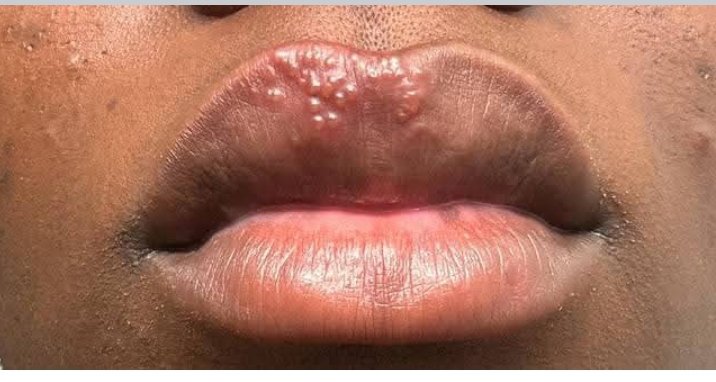 💎 (@azeezadekola6) on Twitter photo Good evening <a href="/Nig_Farmer/">NaijaFarmer</a> Uncle Lanre, how're you, sir? Ma'am and our boy too?
Pls, I do have this on or under my lips each time I treat malaria. What's the cause, and how can it be prevented? Thank you. Good evening <a href="/Nig_Farmer/">NaijaFarmer</a> Uncle Lanre, how're you, sir? Ma'am and our boy too?
Pls, I do have this on or under my lips each time I treat malaria. What's the cause, and how can it be prevented? Thank you.