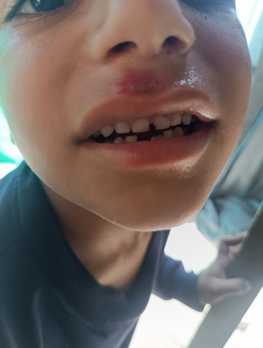 yousefQasem1998's tweet photo. ‼️URGENT‼️ 

Namir  children are SICK with BACTERIA INFECTIONS due to the polluted water and air. HELP THEM GET AID BY D0NATING AND SH@RING!!!

 I NEED 15 PEOPLE, EACH DONATING $25, TO PROVIDE TREATMENT

https://t.co/MQhOVVu3iD
#BB26 https://t.co/QmaR5ss40t