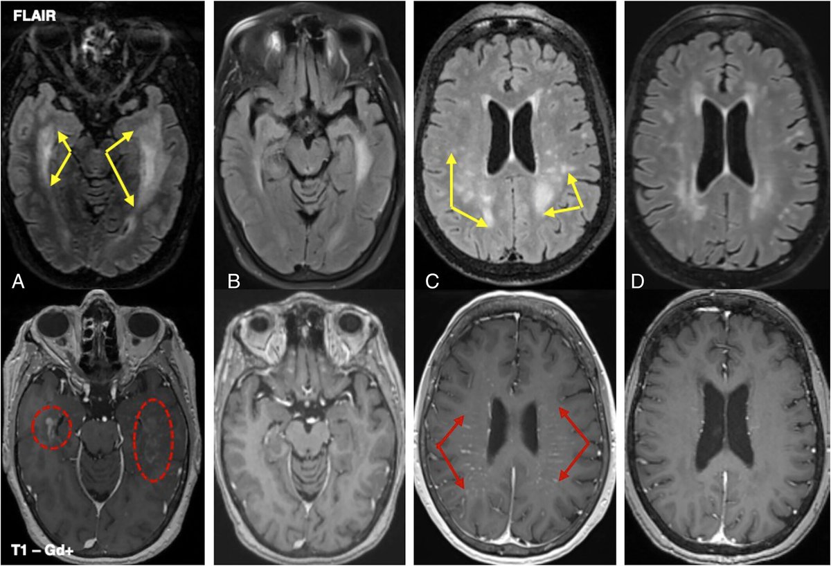 We know CLIPPERS, what about SLIPPERS!🥿🥿
Supratentorial Lymphocytic Inflammation with Parenchymal Perivascular Enhancement Responsive to Steroids - A differential for Anti-GFAP
onlinelibrary.wiley.com/doi/10.1002/an…
