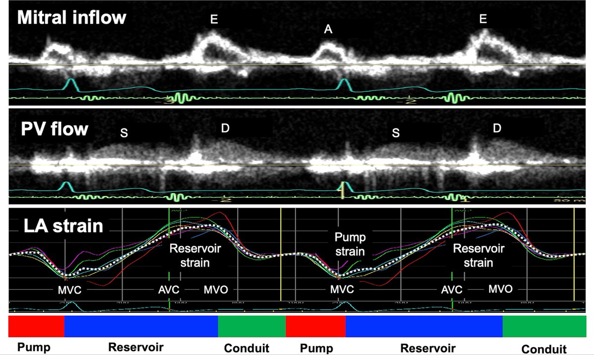 REVIEW ARTICLE
Clinical utility of the left atrial strain analysis doi.org/10.1007/s12574… #Echofirst #CardioEd #echofirst #Cardiology #MedEd