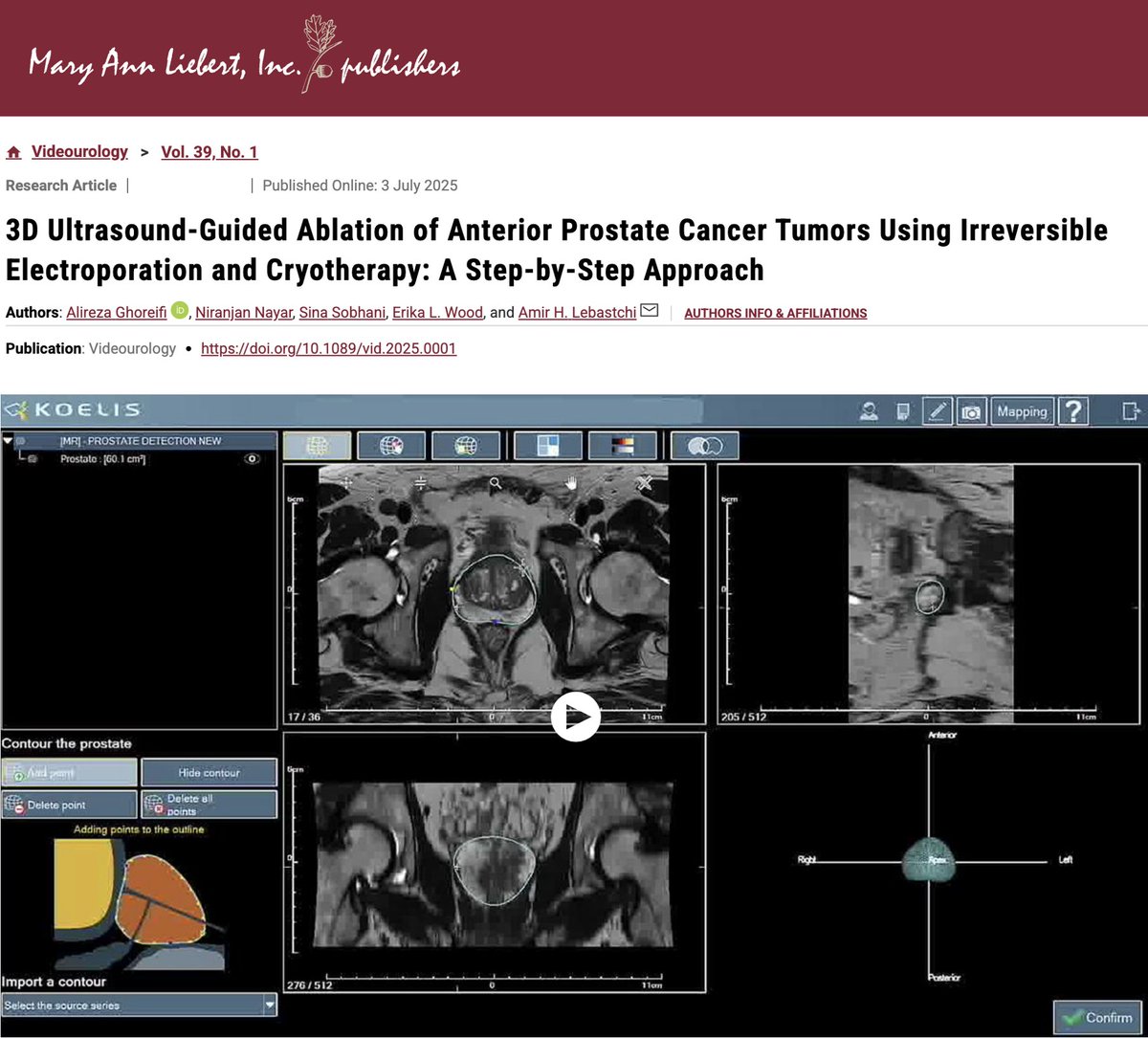 alirezaghoreifi's tweet image. 🔥Our new video article has just been published in @JEndourology #Videourology @LiebertPub
@AmirLebastchi @erikaloulou @USC_Urology
#ProstateCancer #FocalTherapy
🔗liebertpub.com/doi/10.1089/vi…