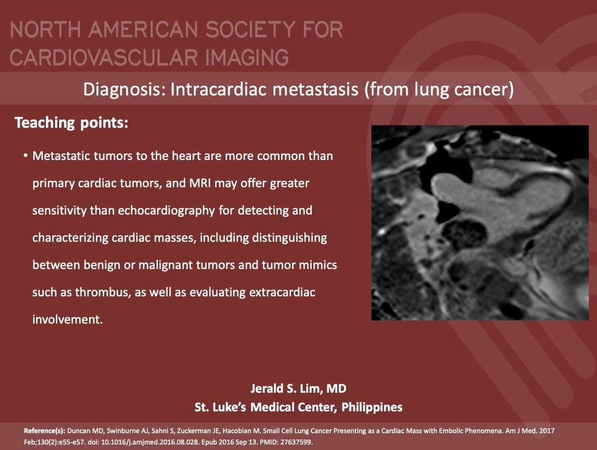 NASCISociety's tweet image. #NASCI Case Series
Case 84 Diagnosis
Courtesy of Jerald S. Lim @jgl_md from St. Luke’s Medical Center, Philippines
#whyCMR #YesCCT
@GregKicska @JRevRad1 @dianalitmano @DanielVargasMD @kirschj @prachipagarwal @AwsHamid5 @EscrOffice @CarlottaOnnis @DeCeccoCN