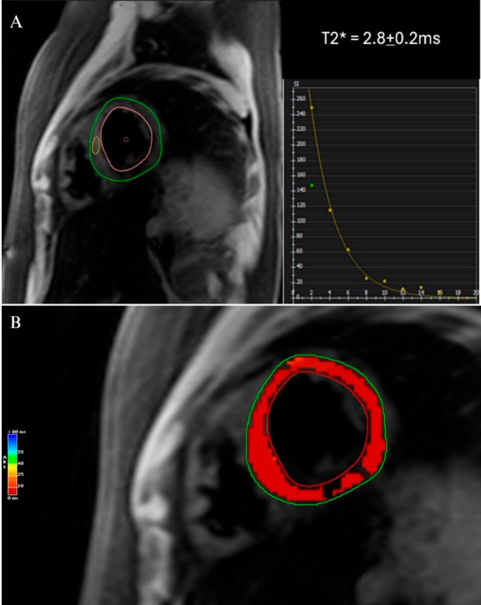 Excited to share our contemporary review on primary and secondary cardiac iron overload published in <a href="/Hearts_MDPI/">Hearts MDPI</a> 
<a href="/TomKMWang/">Tom Wang MBChB MD</a> <a href="/JeldahdahMD/">Joseph El Dahdah</a> <a href="/ElioHarounMD/">Elio Haroun</a> <a href="/TiffanyDong6/">Tiffany Dong</a> 

mdpi.com/2673-3846/6/3/…