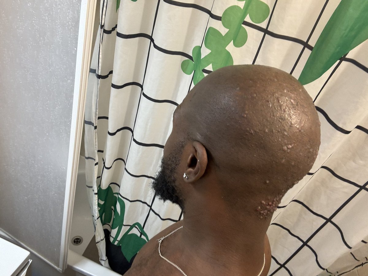 sheloveskvn's tweet image. Bonjour , j’aurais besoin d’un maximum de rt parce que je supporte plus. J’ai ces plaques de boutons qui apparaissent à l’arrière de mon crâne, j’ai vu des dermatos mais ils m’ont tous dit qu’ils savaient pas ce que c’etait. Alors est ce quelqu’un sait ce que c’est?