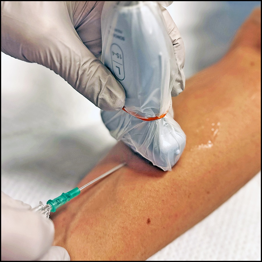 Read a summary of "Guidelines for performing ultrasound-guided vascular cannulation: Recommendations of the American Society of Echocardiography," in the June 2025 Science, Medicine, and the Anesthesiologist: ow.ly/Rn8F50Wjh2a