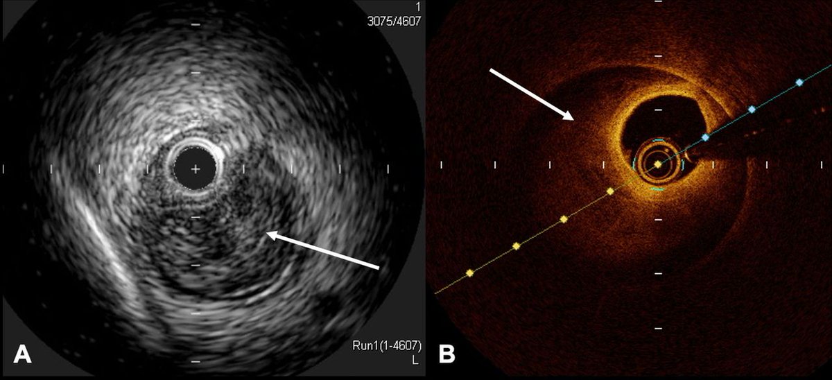 Heart_BMJ tweet media