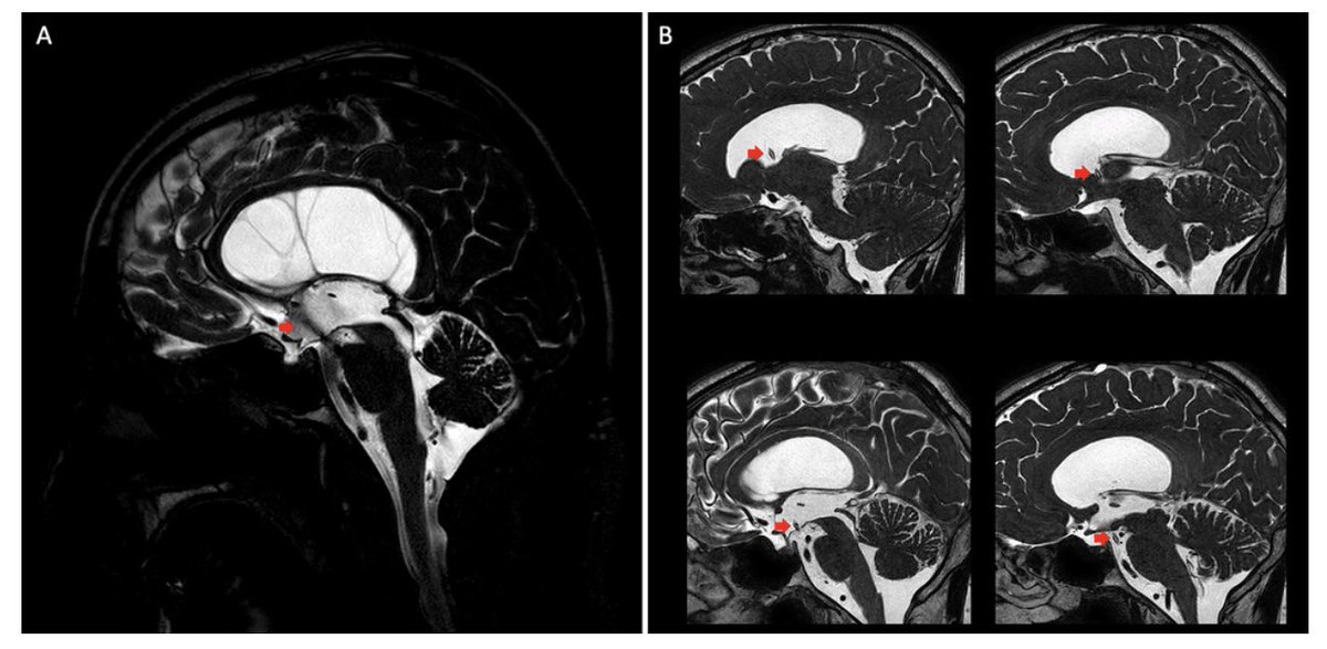 TheJNS's tweet image. #OnlineFirst: Development of a virtual dissection environment integrated into cadaveric dissection for skull base anatomy education.
thejns.org/view/journals/….