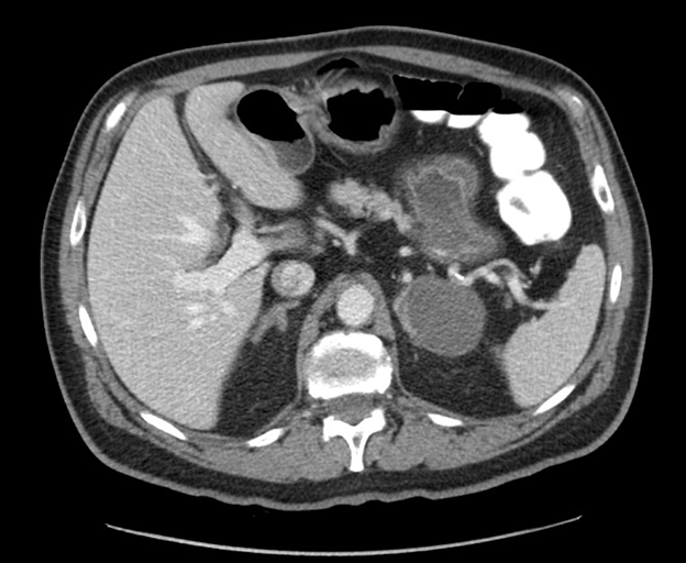 I learned this week that SABR-COMET patient #1 recently passed away, more than 12 years after enrollment, with no recurrence since his original SABR. 

We initially treated him for a left adrenal met. It’s an interesting story… ⬇️⬇️⬇️