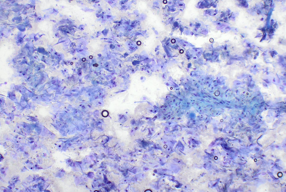The two malignant faces of ROSE: Adenocarcinoma and squamous cell carcinoma in toluidine blue mode.
Blue metastasis 🩵 <a href="/MerceJorda1/">Merce Jorda</a> <a href="/tlabiano/">Tania Labiano</a> <a href="/citologiala/">citologiala</a> <a href="/lara_pijuan/">Lara Pijuan,MD PhD,MIAC</a> <a href="/corinacu16/">Corina Castañeda</a>  <a href="/FridaRosenblum/">Frida Rosenblum</a>