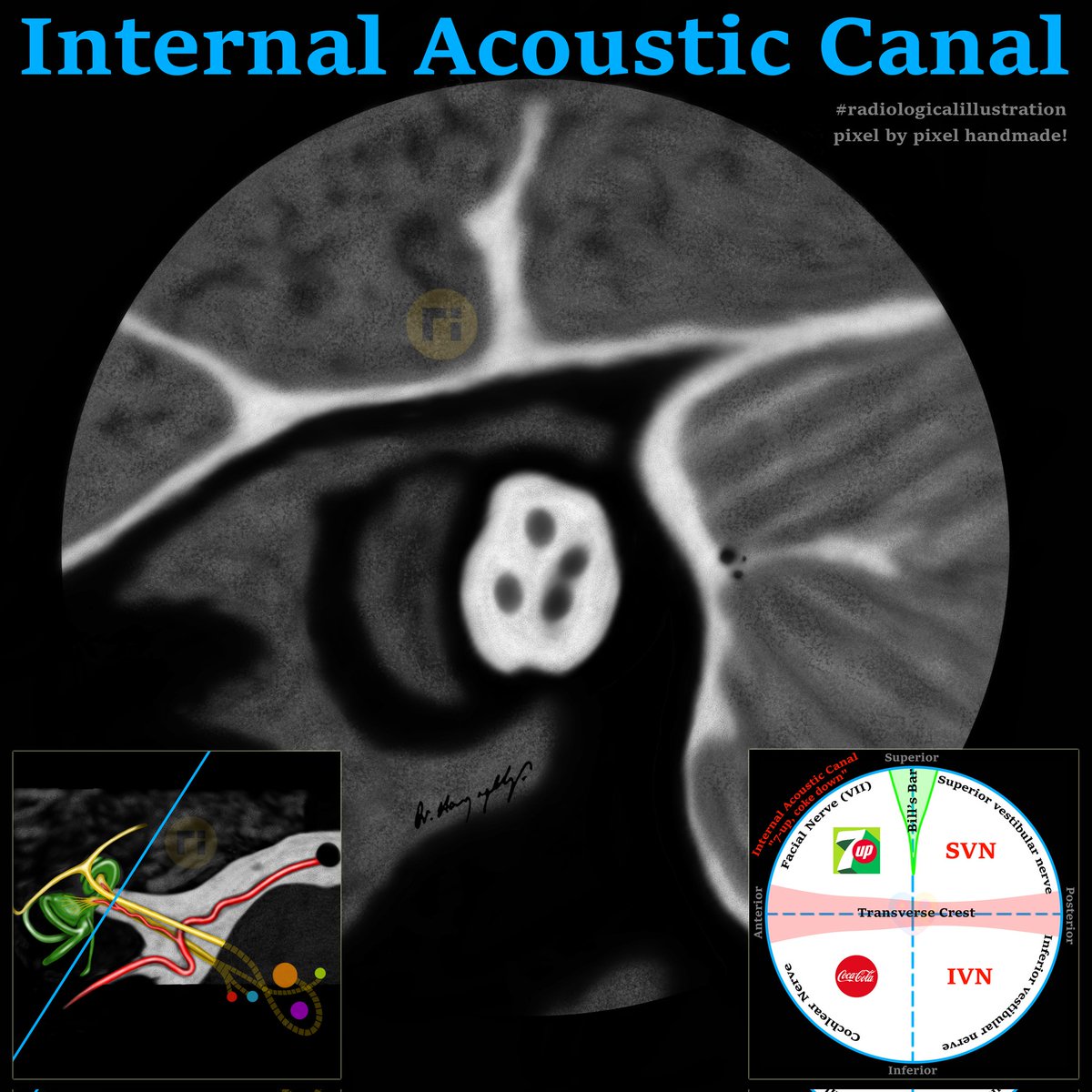 drharunyildiz's tweet image. Internal Acoustic Canal
#radiologicalillustration ✍️
pixel by pixel handmade!