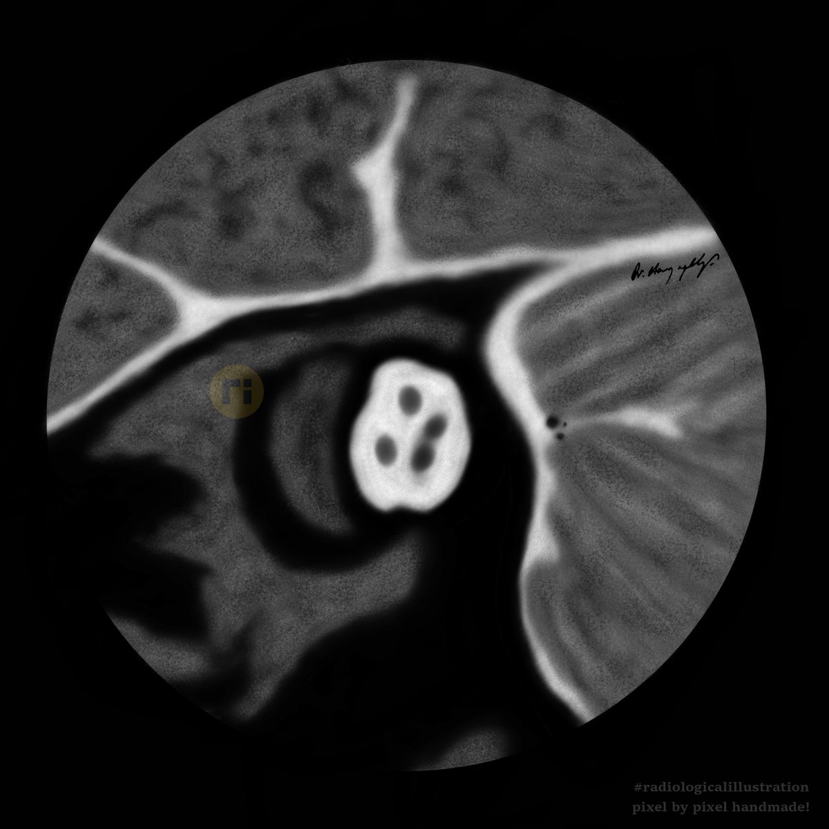 drharunyildiz's tweet image. Internal Acoustic Canal
#radiologicalillustration ✍️
pixel by pixel handmade!