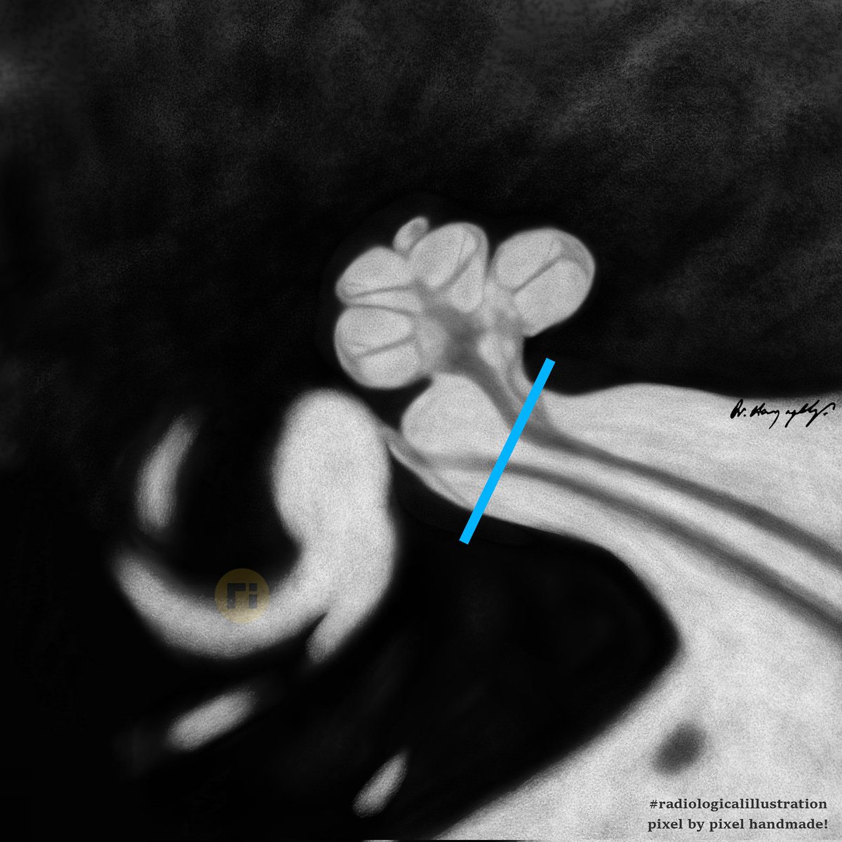 drharunyildiz's tweet image. Internal Acoustic Canal
#radiologicalillustration ✍️
pixel by pixel handmade!