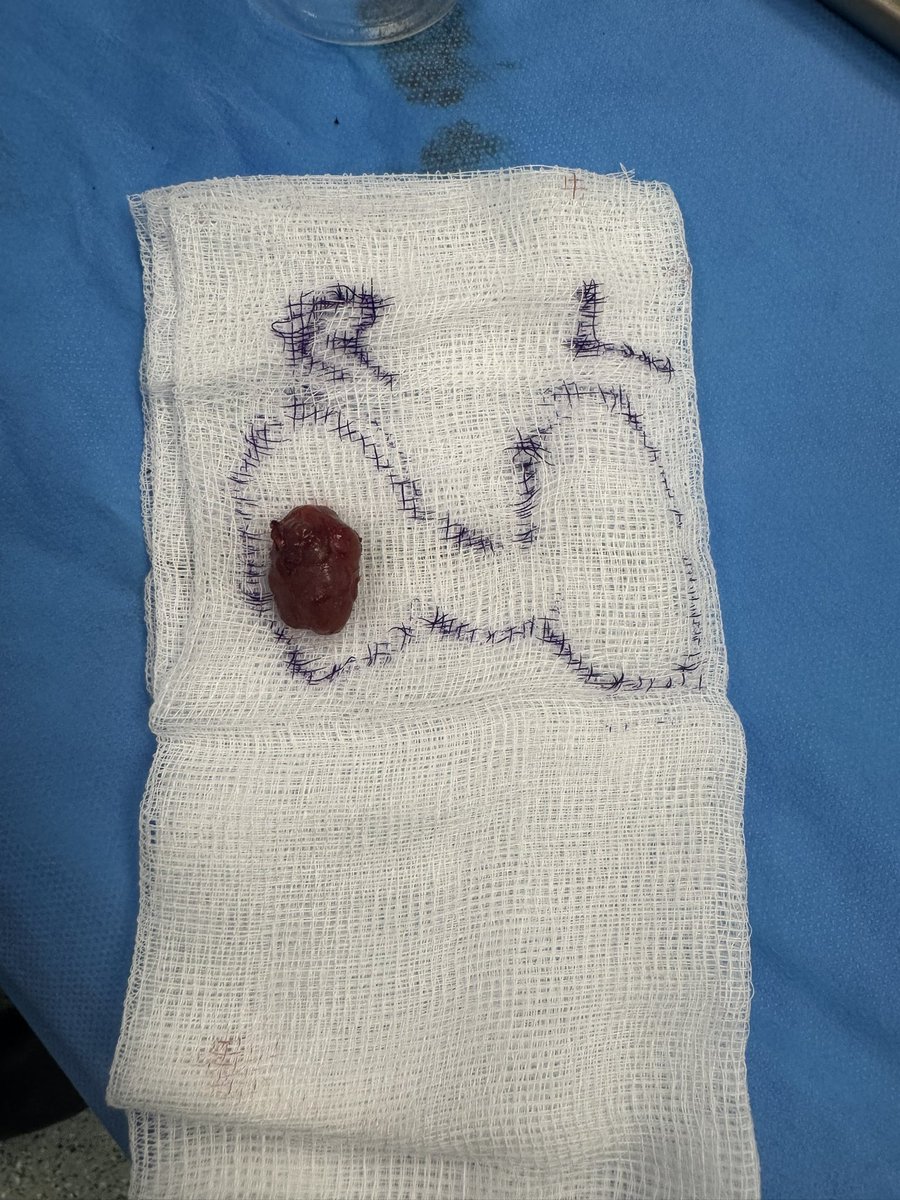 Ram Moorthy (@rammoorthyent) on Twitter photo Another successful transoral parathyroidectomy undertaken with <a href="/siddini5/">Sid Nagala</a> . Great to be able to use intraop PTH <a href="/RBNHSFT/">Royal Berkshire NHS Foundation Trust</a>, which confirmed success 15mins after excision Another successful transoral parathyroidectomy undertaken with <a href="/siddini5/">Sid Nagala</a> . Great to be able to use intraop PTH <a href="/RBNHSFT/">Royal Berkshire NHS Foundation Trust</a>, which confirmed success 15mins after excision