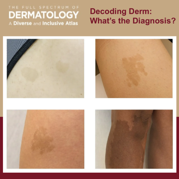 Journal of Drugs in Dermatology (JDD) (@jddonline) on Twitter photo Test Your Knowledge! 
Join Dr. Alexis Carrington, Chief Dermatology Resident at George Washington University, to help understand dermatologic conditions across all skin tones. 
vocalvideo.com/v/jdd-reviews-… Test Your Knowledge! 
Join Dr. Alexis Carrington, Chief Dermatology Resident at George Washington University, to help understand dermatologic conditions across all skin tones. 
vocalvideo.com/v/jdd-reviews-…