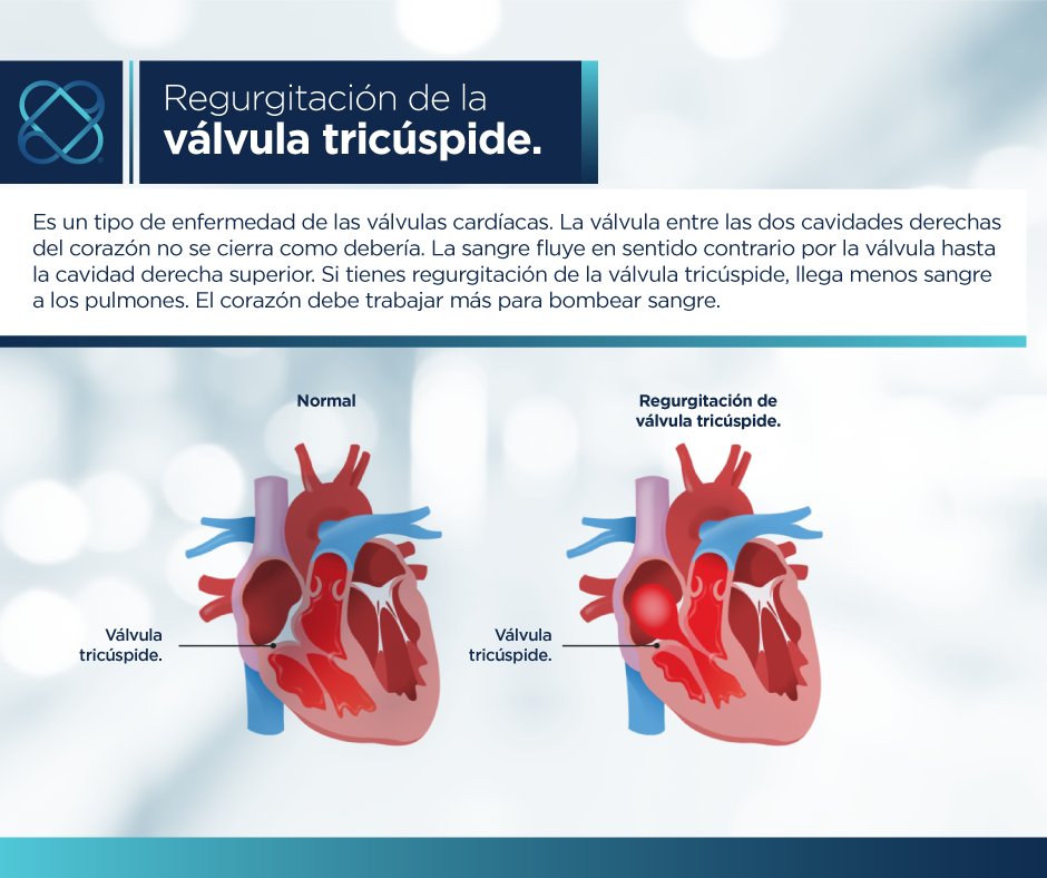 #ConocimientoICMI
Hablemos de la regurgitación de la válvula tricúspide.
#SaludCardiovascular #VálvulaTrucúspide
👉¿Necesitas una valoración médica? 
☎ 33 3621 0808 y 3336210531
📱 WhatsApp 3316031390
📍Blvd. Puerta De Hierro 5090 Piso 1, S/N Col. Puerta de Hierro, Zapopan, Jal.