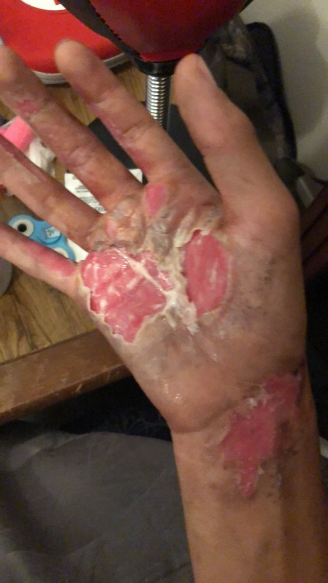 Few years ago on the 4th I had a firework go off in my hand, burned all the skin off of it. Luckily I threw it and it exploded 10ft away instead of taking my arm off

People are 100% losing their hands today so be hyper aware