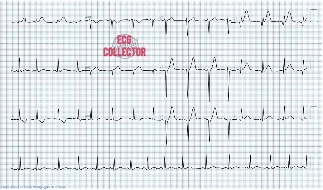 Dr Razi (@drrazi4) on Twitter photo 31 y.o male with chest pain for 1 hour; risk factor- smoker.
What will <a href="/PMcardioApp/">PMcardio—AI that reads ECGs</a> QoH say🤔❓
#cardiotwitter
#CardioEd
#Cardiology
#Medicalstudent
#MedTwitter 31 y.o male with chest pain for 1 hour; risk factor- smoker.
What will <a href="/PMcardioApp/">PMcardio—AI that reads ECGs</a> QoH say🤔❓
#cardiotwitter
#CardioEd
#Cardiology
#Medicalstudent
#MedTwitter