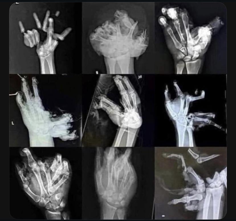 Today is someone is ending the day with less fingers than they woke up with.

A fitting metaphor.

Happy 4th 🇺🇸