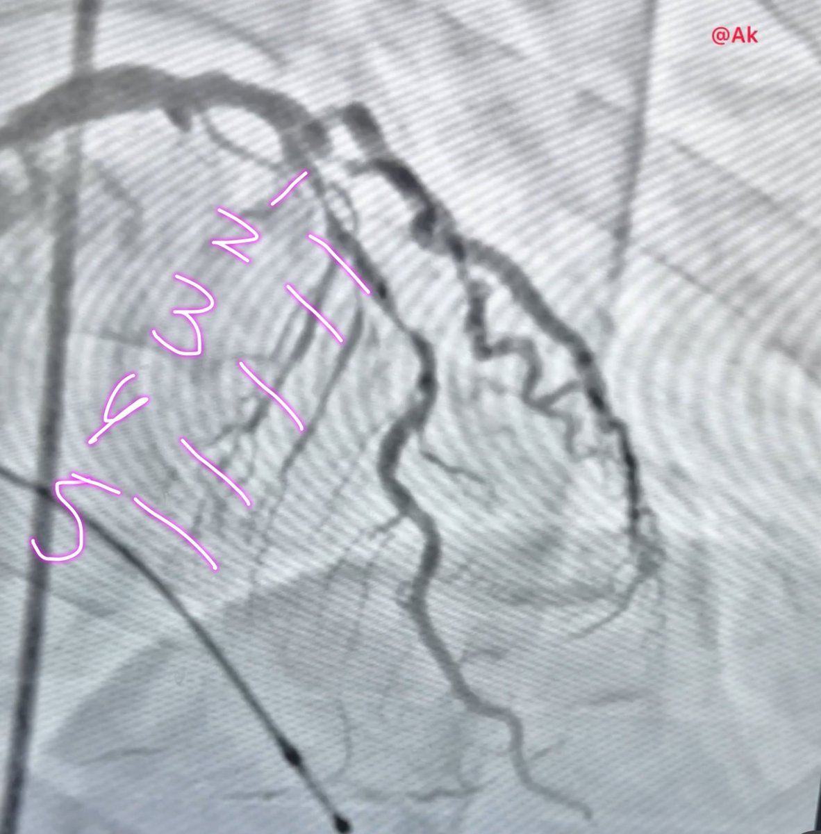 #Basic_IC_LEARNING_01
For us , the community of interventional cardiologist , we see HEART through the lens of dye and floroscopy more than anything else and hence assessment of complication and understanding has to be like this also for so many things like TAVR / STEMI / VSD