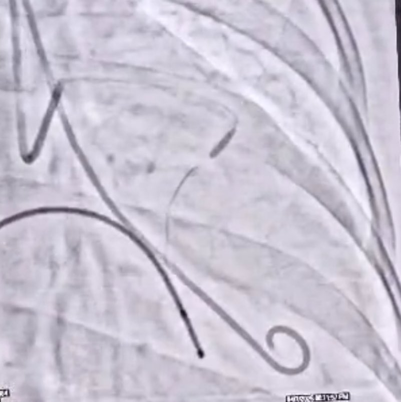 #Basic_IC_LEARNING_01
For us , the community of interventional cardiologist , we see HEART through the lens of dye and floroscopy more than anything else and hence assessment of complication and understanding has to be like this also for so many things like TAVR / STEMI / VSD