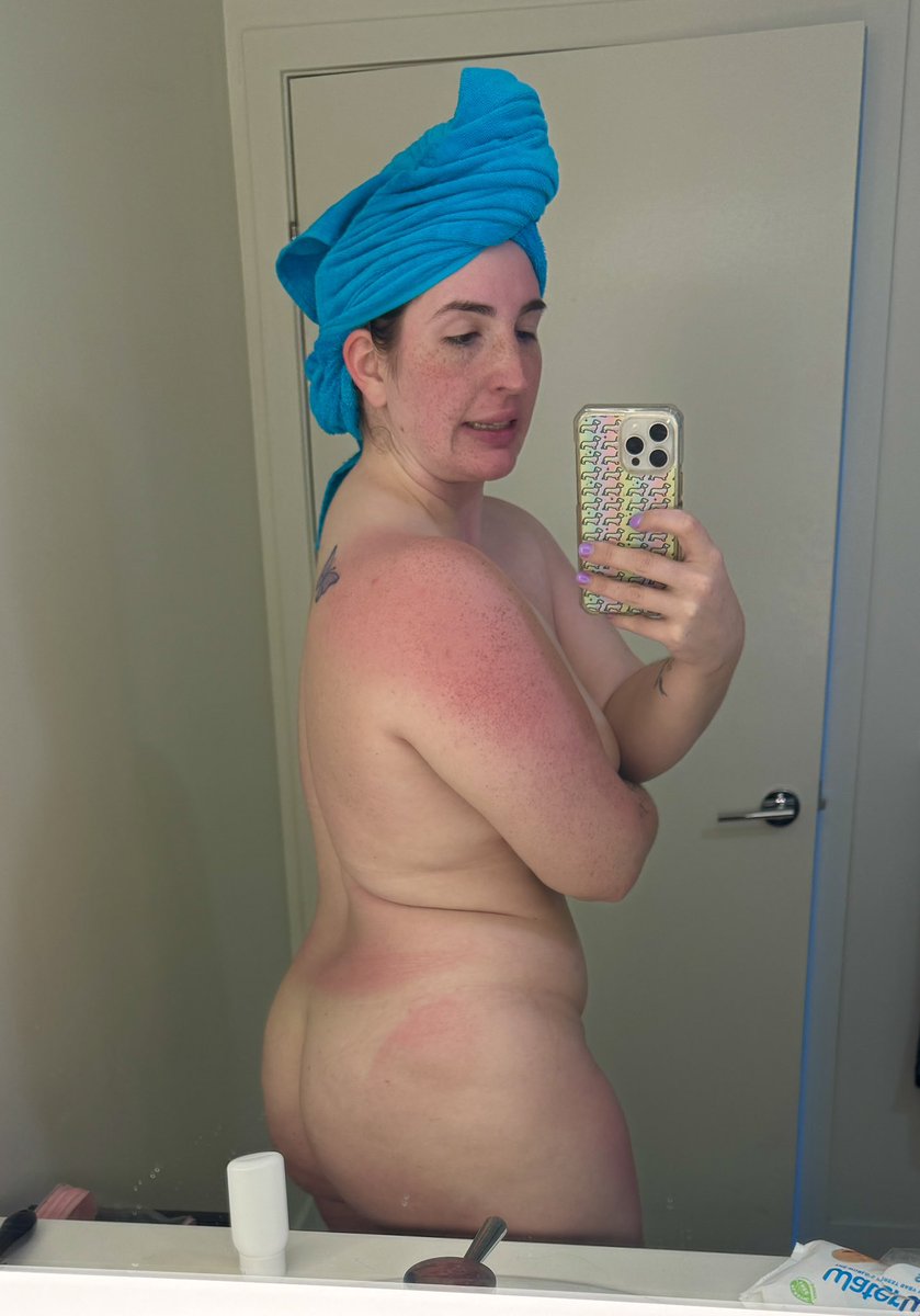 Welp, went on a drive. Got half my body sunburnt. 😬

I pray it doesn’t tan.