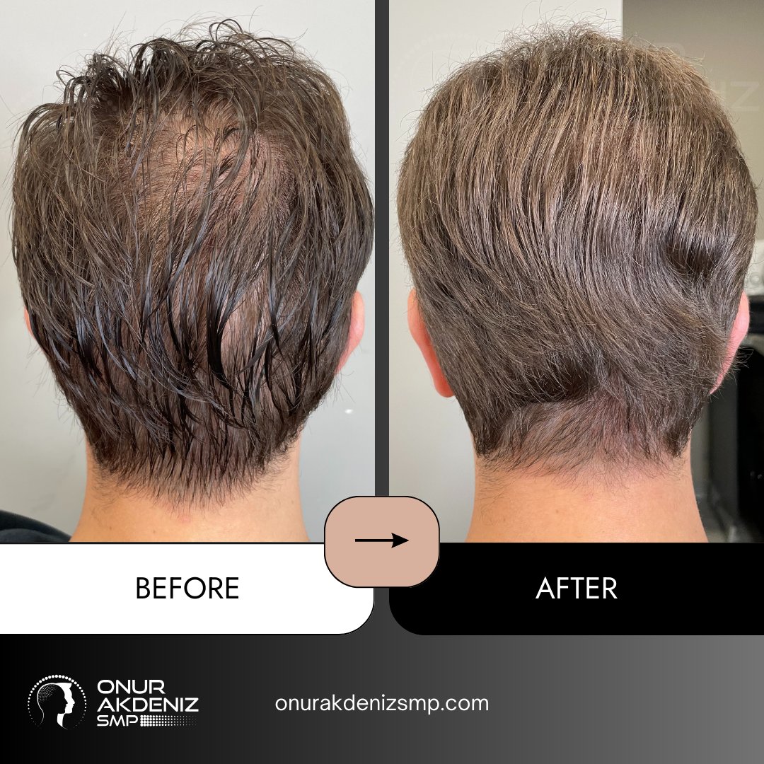 onurakdenizsmp's tweet image. ✨ From patchy to polished.
Micropigmentation is the missing touch your transplant needed.

No surgery, no stress — just natural-looking density and confidence, restored.
🎯 Expertly done by Onur Akdeniz SMP in Istanbul.

#scalpmicropigmentation #micropigmentation…