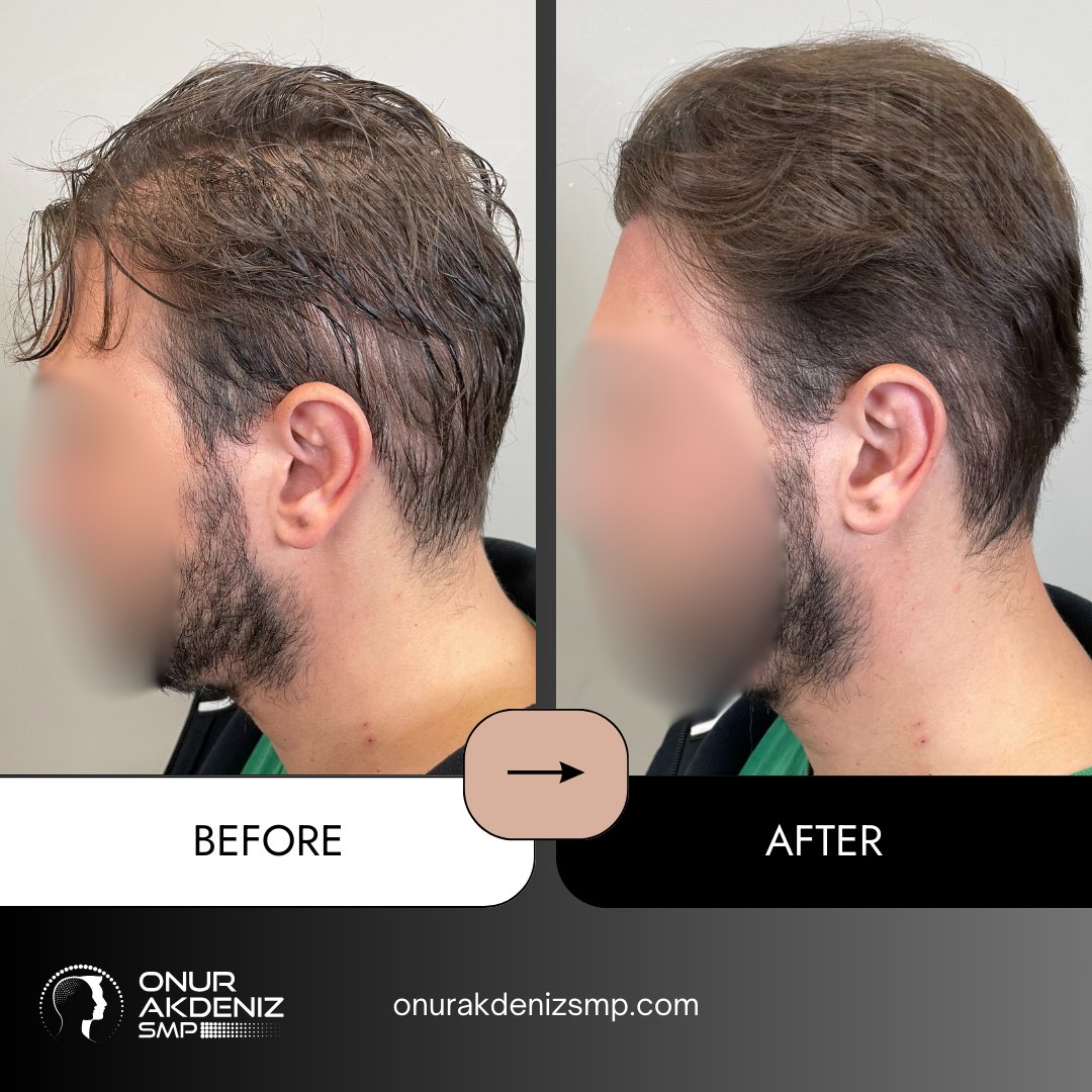 onurakdenizsmp's tweet image. ✨ From patchy to polished.
Micropigmentation is the missing touch your transplant needed.

No surgery, no stress — just natural-looking density and confidence, restored.
🎯 Expertly done by Onur Akdeniz SMP in Istanbul.

#scalpmicropigmentation #micropigmentation…
