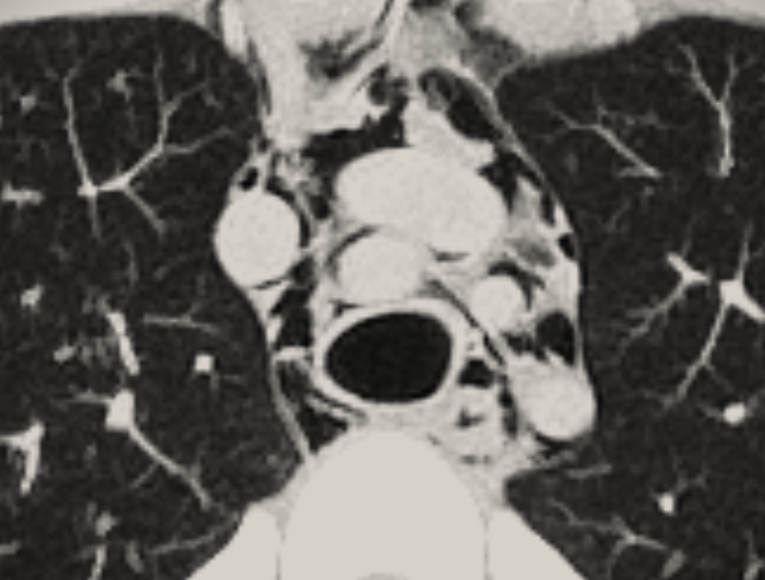#PLEURAL_PEARLS_WA 34
Pneumomediastinum is rare; associated with smoking/inhaled drugs; trauma; iatrogenic procedures. Chest pain, dyspnea, dysphagia often settle with conservative care. Easy to miss on CXR; CT best for diagnosis/see extent.   

<a href="/tsanz_thoracic/">TSANZ</a> <a href="/AAB_IP/">AABIP</a>