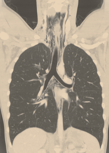 YCGaryLee's tweet photo. #PLEURAL_PEARLS_WA 34
Pneumomediastinum is rare; associated with smoking/inhaled drugs; trauma; iatrogenic procedures. Chest pain, dyspnea, dysphagia often settle with conservative care. Easy to miss on CXR; CT best for diagnosis/see extent.   

@tsanz_thoracic @AAB_IP @wabipconnect @iPulmOG  @PleuralPOCUS @ALATorax @PulmPEEPs @CHESTOncology @UKPleura @ARNS_UK