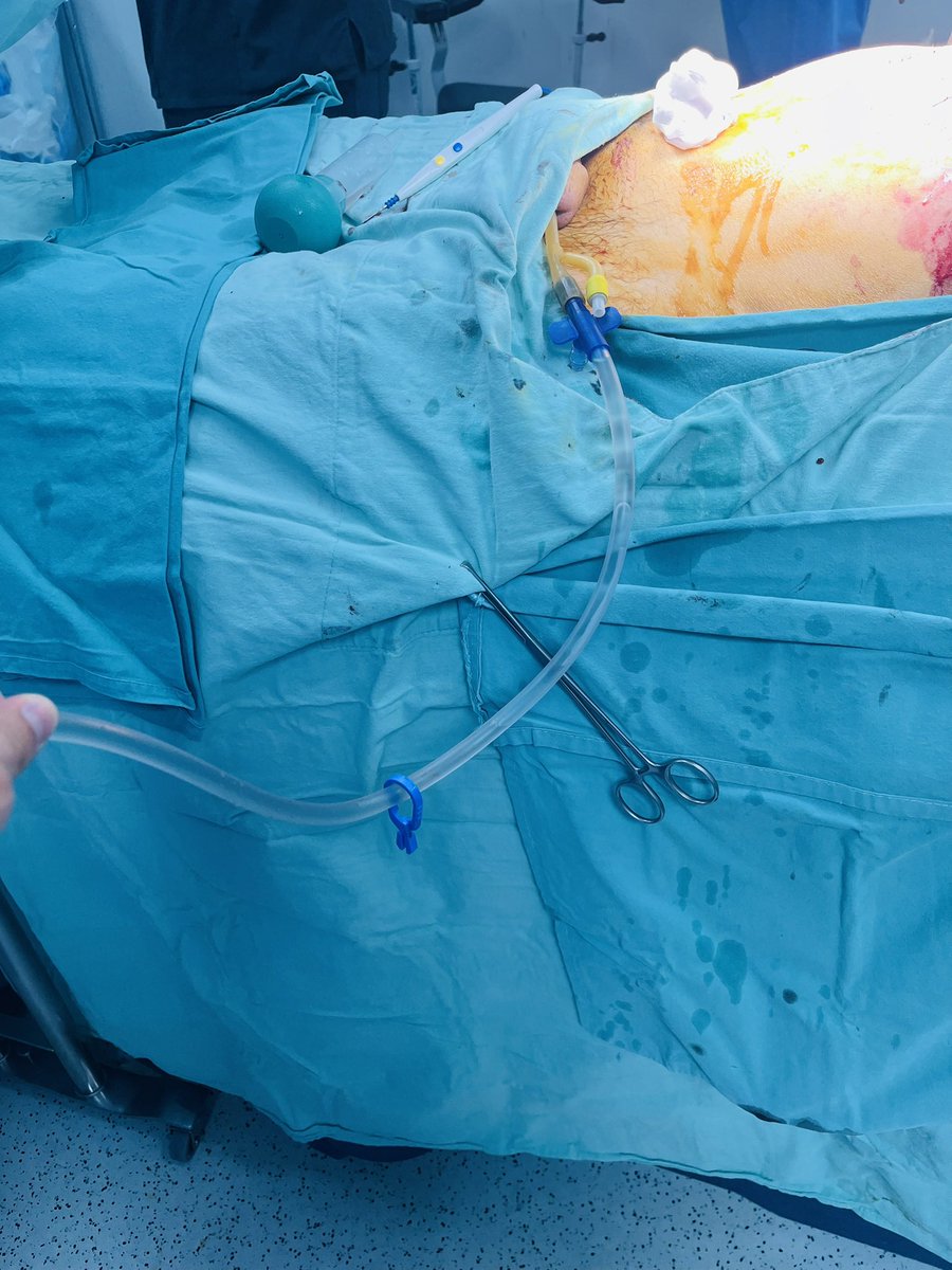 Hoy realizamos prostatectomía simple asistida por robot con preservación uretral (técnica de Madigan). Uretra conservada, 50 ml de sangrado, 3hr 58 min de consola, sin hematuria transoperatoria…
<a href="/Urologos_UMANO/">Grupo Médico UMANO</a> <a href="/DoctorArriaga/">Dr. Juan Arriaga</a> <a href="/so_uro/">UroSoMe</a> <a href="/DrPacoGarcia/">Francisco Enrique García Martínez</a> <a href="/arieluro/">@dr_arieluro</a> <a href="/CIMAHMO/">Hospital CIMA HMO</a>