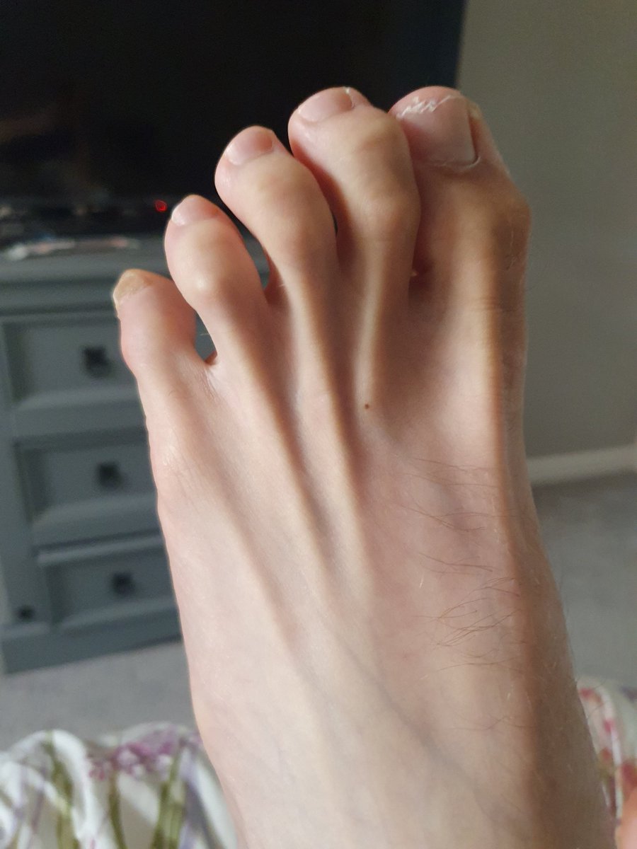 nickblackwell02's tweet image. My Toes look Deformed‼️
My Paralysed left foot and Toes were bad enough due to my TBI. Since my episode at the weekend in hospital it's got severe, worse and more locked.
I have been refered to the Hospital next month to see the big consultants in the Foot Trauma Clinic as my…
