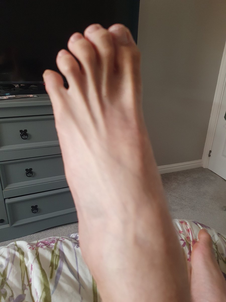 nickblackwell02's tweet image. My Toes look Deformed‼️
My Paralysed left foot and Toes were bad enough due to my TBI. Since my episode at the weekend in hospital it's got severe, worse and more locked.
I have been refered to the Hospital next month to see the big consultants in the Foot Trauma Clinic as my…