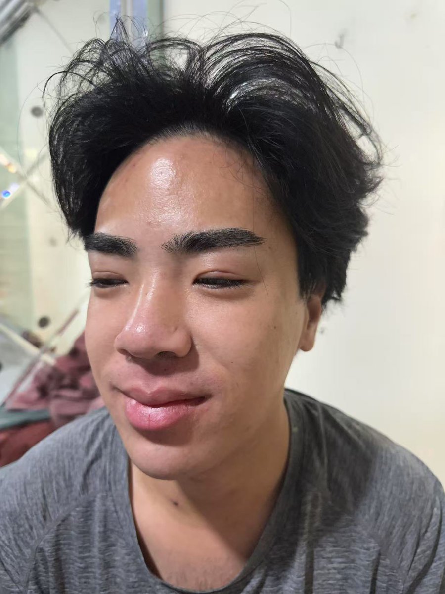 脱络腮胡前后对比 妈呀显得人干净好多呀

+v bethebeauty12345 領取內部底價表 （私信不回復）MTF 面部女性化隆胸豐臀抽脂皮膚科牙科磨骨
咨询v：bethebeauty12345 

mtf #ts #雌二醇 #雌激素 #补佳乐 #克龄蒙 #爱斯妥 #凝胶 #色普龙 #华典 #比卡鲁胺 
#药娘 #伪娘 #变性