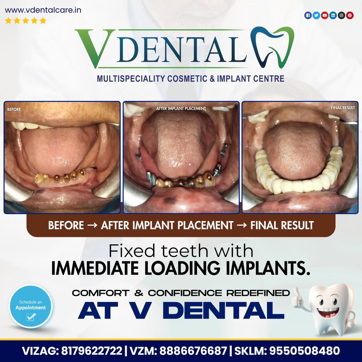 vdentalhospital's tweet image. 🦷 Transform Your Smile with IMMEDIATE LOADING IMPLANTS!

At V DENTAL – Multispeciality Cosmetic &amp;amp; Implant Centre, we bring you advanced implant solutions for a confident smile and comfortable lifestyle.

📞 8179622722
📞 8886676687
📞 9550508480

#ImmediateLoadingImplants