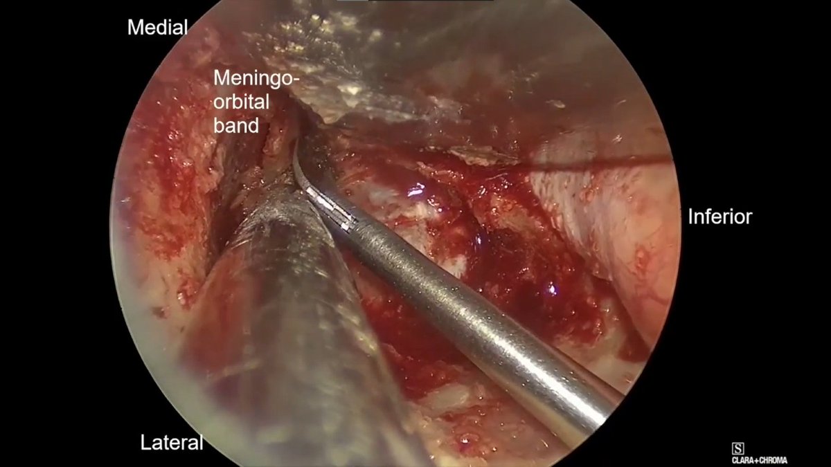 TheJNS's tweet image. #OperativeVideo Transorbital endoscopic approach for repair of a lateral sphenoid sinus cerebrospinal fluid leak
thejns.org/video/view/jou…