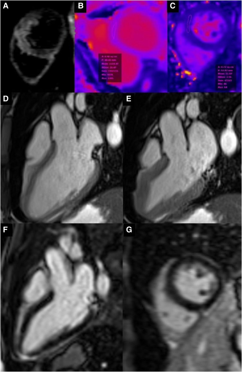 EHJCVIEiC's tweet image. 🫀 Rare alert: Acute focal myocarditis linked to gilteritinib, a novel TKI, highlights potential FLT3-related cardiotoxicity. Clinicians should be aware of myocarditis as part of the TKI cardiotoxicity spectrum. #CardioOncology #Myocarditis #TKI 🔗 doi.org/10.1093/ehjci/… #EHJCVI