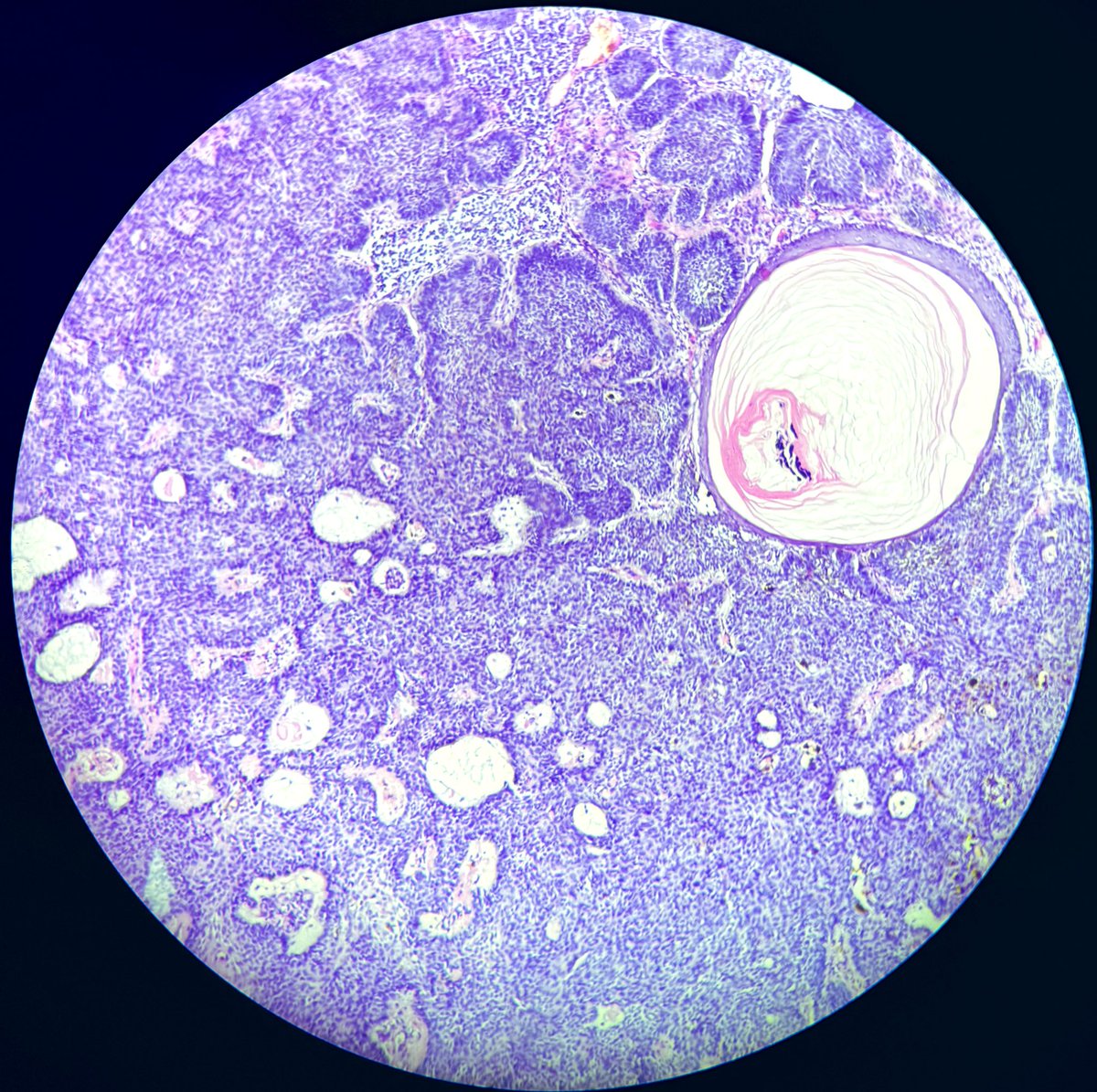 Drmona1995's tweet photo. 75 F. Lesion over forehead 15 years
Image 1: showing origin of the tumour from the skin lining.
Image 2&3: Beautiful Basaloid cells with microcysts in between.
Image 4: showing Melanin Pigment.
What am i?
#dermatopath #histology #pathology https://t.co/IWFMuPiGeo